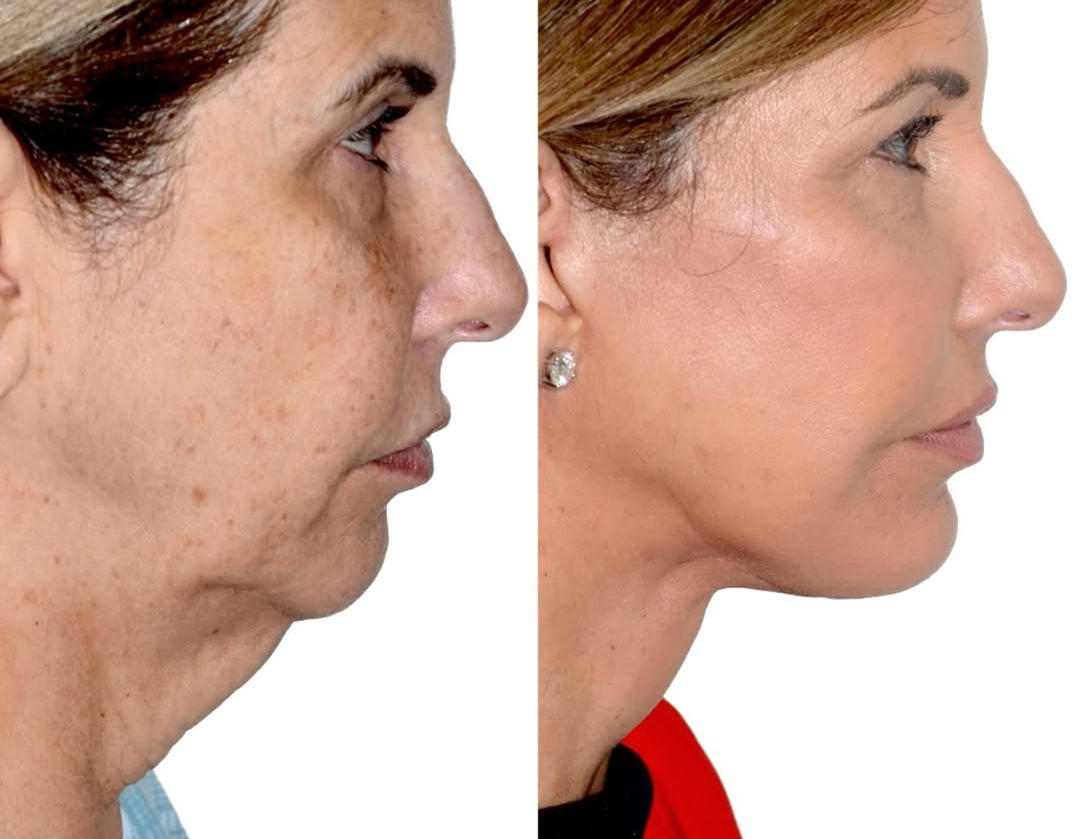 deep-plane-facelift-1-year