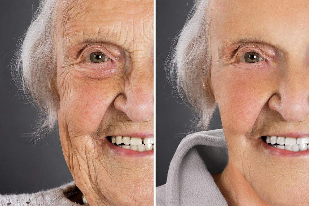 Patients often enjoy visible improvement for 10 to 15 years or longer