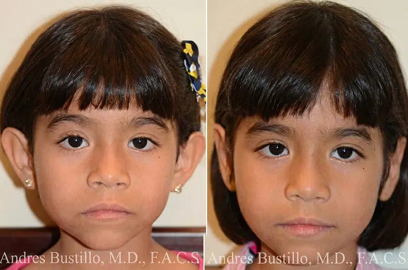 Otoplasty and Ear Pinning Procedures