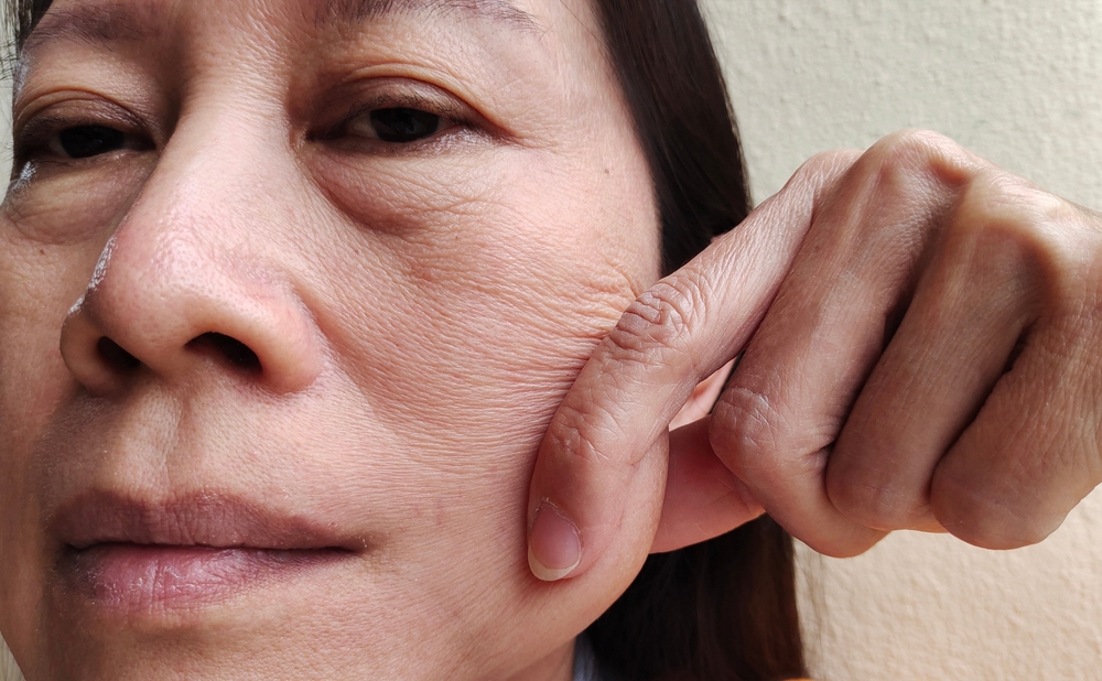 Sagging of the cheeks or midface is a signt you need Deep Plane Facelift