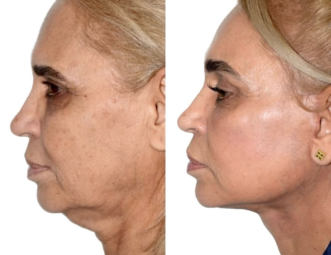 Before and after side view of woman highlighting smoother jawline and facial rejuvenation from deep plane facelift.