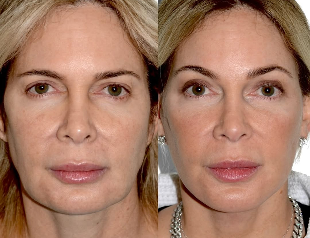 Before and after photos of a woman showing facelift recovery progress and improved facial contours over several months.