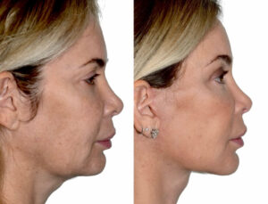 Side-by-side before and after images of a woman showing improved facial contours from a deep plane facelift.