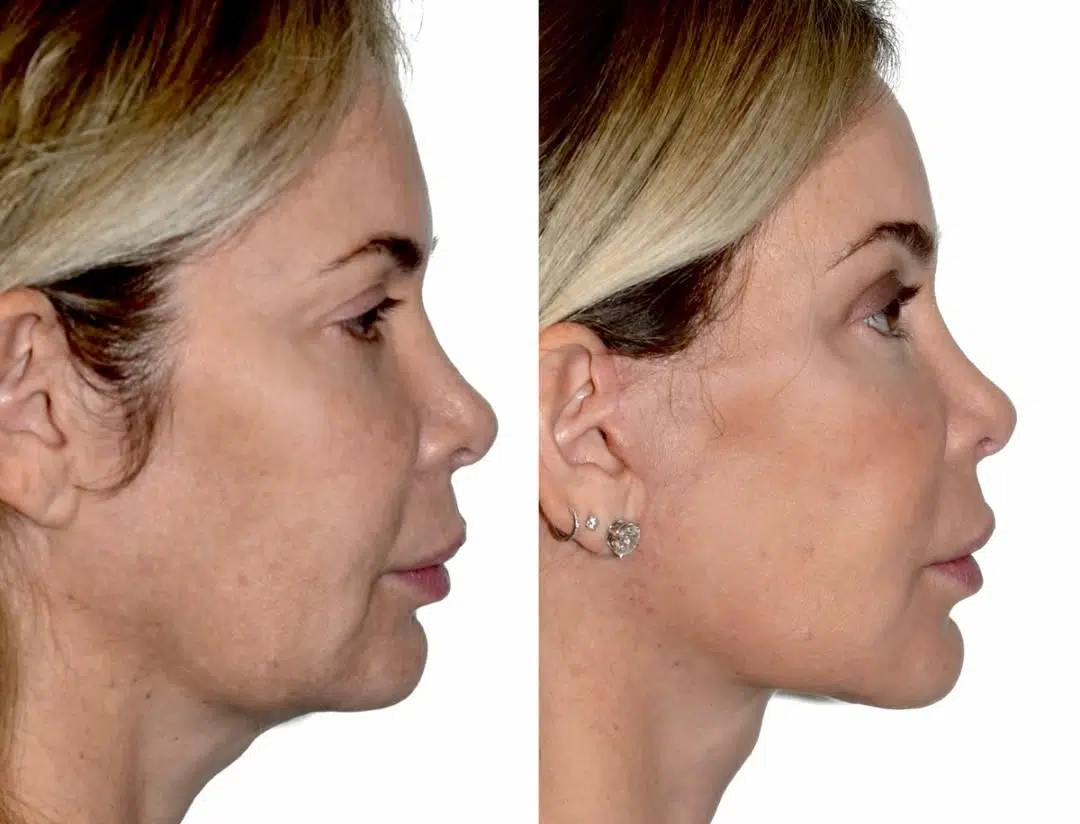 Side-by-side before and after images of a woman showing improved facial contours from a deep plane facelift.