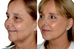 Side-by-side before and after facelift images showing smoother skin and improved facial definition from proper surgical preparation.