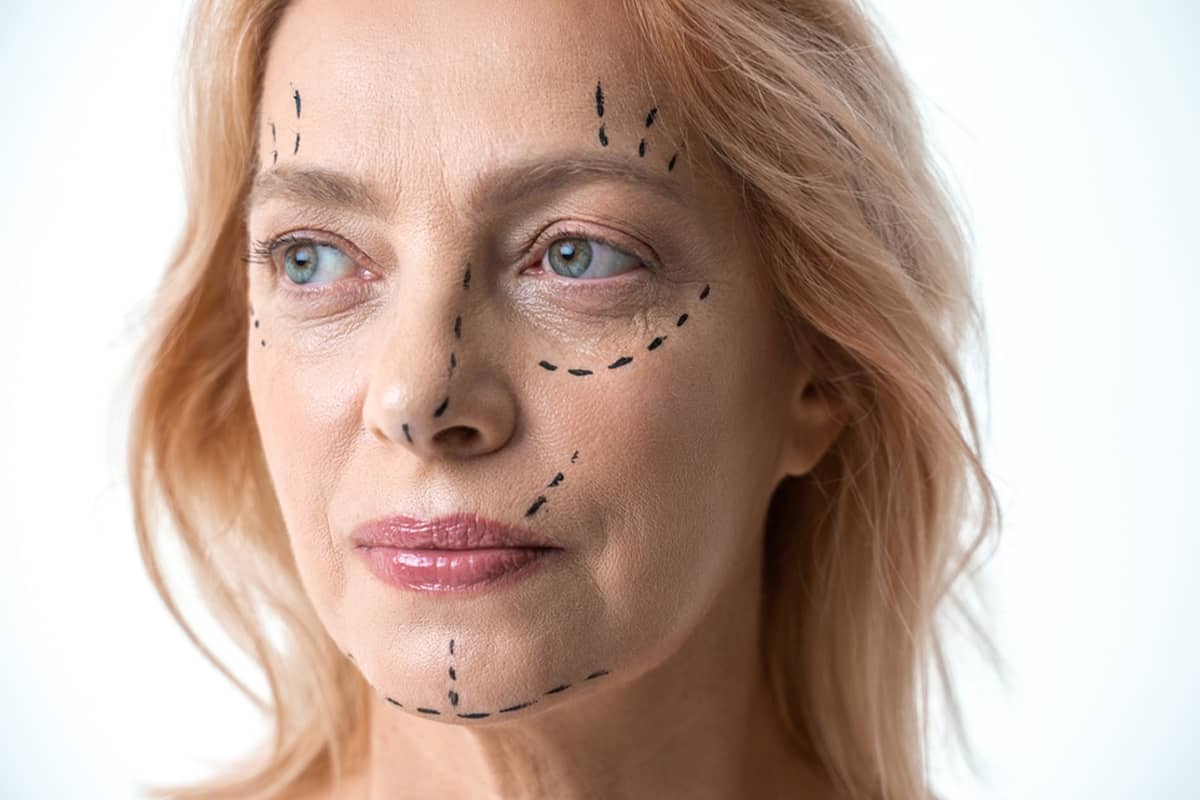 A woman's face with white directional arrows showing the comprehensive lifting vectors used in a deep plane facelift to reposition the entire midface and neck.