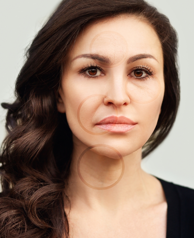 Loose skin after facelift surgery does not necessarily indicate a complication or surgical failure