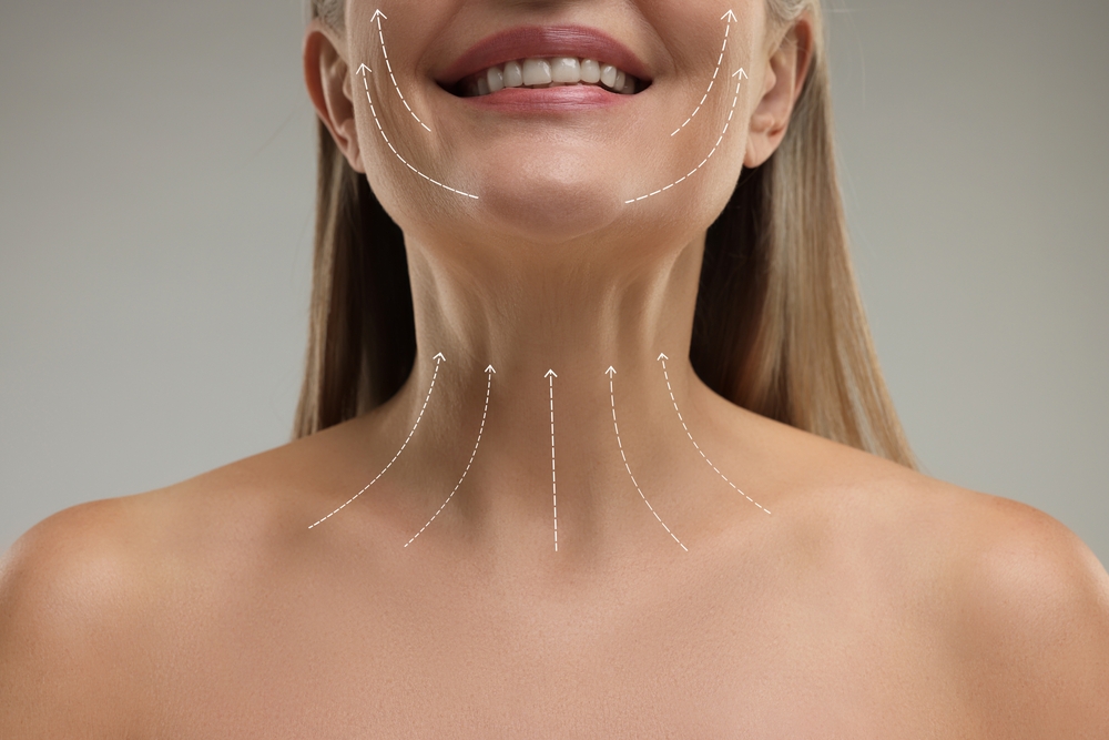 Lower face and neck with arrows illustrating lifting effects of deep plane facelift versus neck lift procedures.