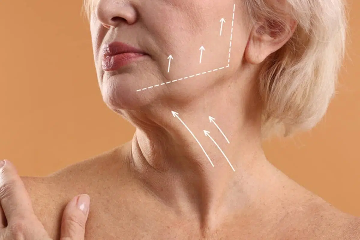 A close-up of a woman’s lower face and neck with white dashed arrows indicating the lifting vectors for a deep plane facelift.