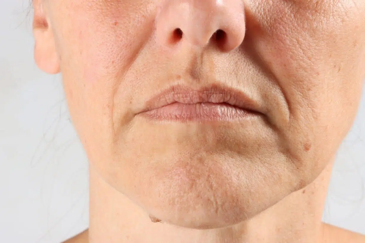 Close-up of lower face showing deep nasolabial folds and skin laxity, indicating candidacy for facelift procedure