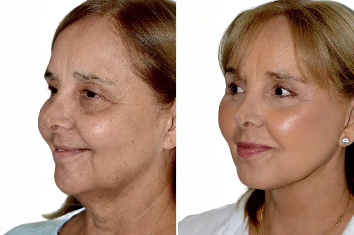 Brow Lift Before and After Photos in Miami, FL, Patient 29953