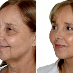 Brow Lift Before and After Photos in Miami, FL, Patient 29953