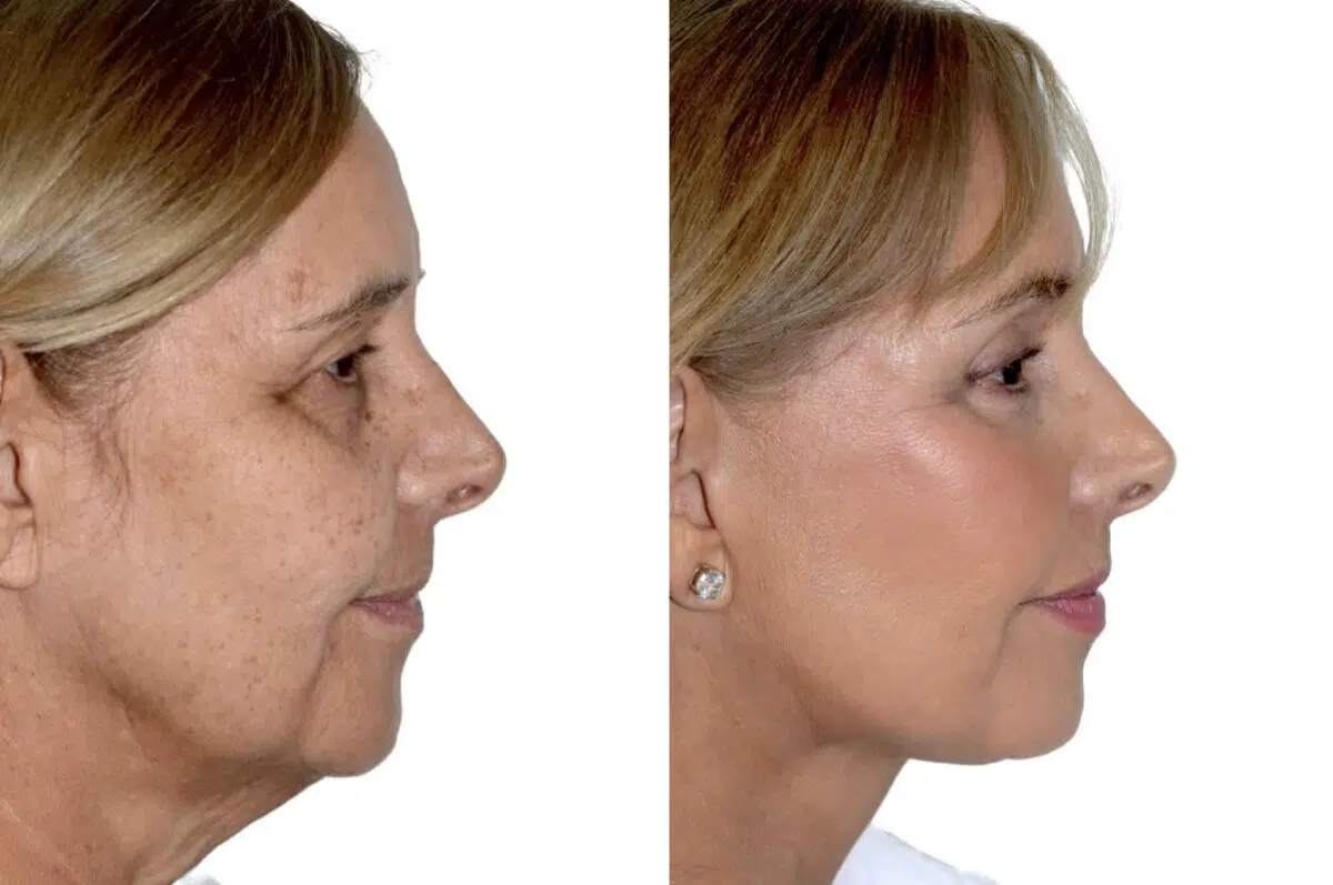 Brow Lift Before and After Photos in Miami, FL, Patient 29953