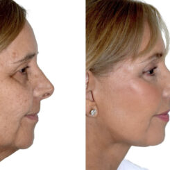 Brow Lift Before and After Photos in Miami, FL, Patient 29953