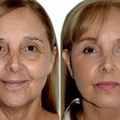 Brow Lift Before and After Photos in Miami, FL, Patient 29953
