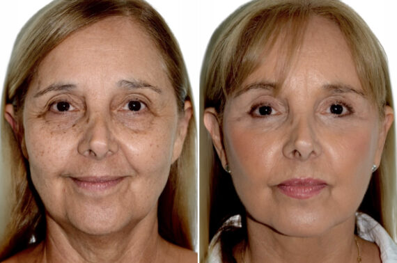 Brow Lift Before and After Photos in Miami, FL
