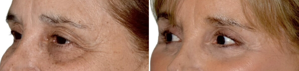 Blepharoplasty (eyelids) Before and After Photos in Miami, FL, Patient 29963