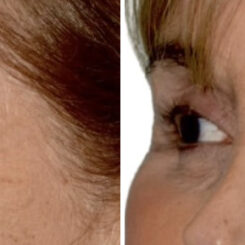 Blepharoplasty (eyelids) Before and After Photos in Miami, FL, Patient 29963