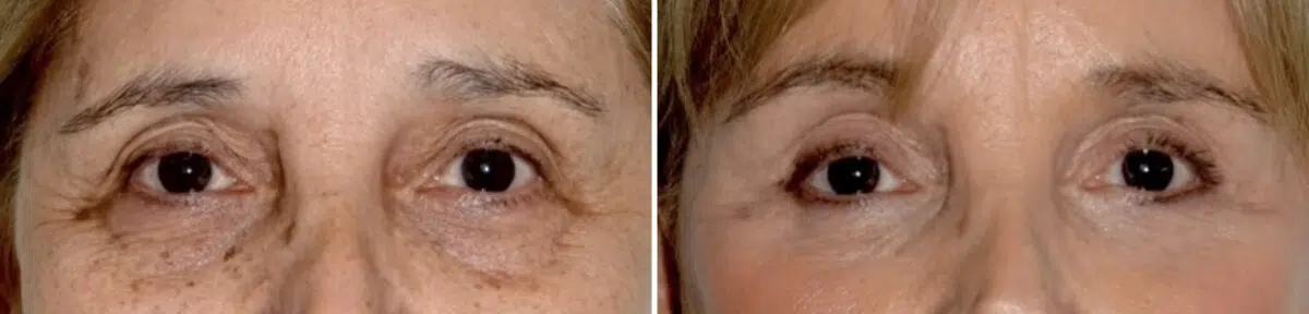 Blepharoplasty (eyelids) Before and After Photos in Miami, FL, Patient 29963