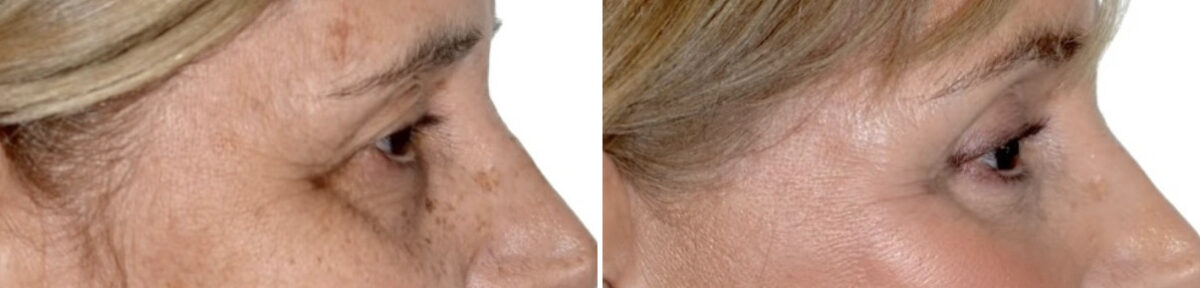 Blepharoplasty (eyelids) Before and After Photos in Miami, FL, Patient 29963