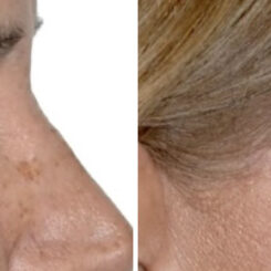 Blepharoplasty (eyelids) Before and After Photos in Miami, FL, Patient 29963