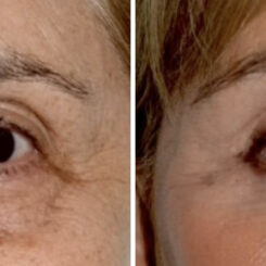 Blepharoplasty (eyelids) Before and After Photos in Miami, FL, Patient 29963