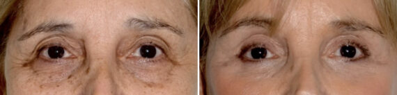 Blepharoplasty (eyelids) Before and After Photos in Miami, FL, Patient 29963