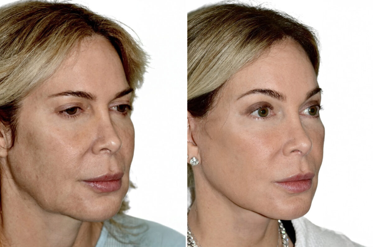 Deep Plane Facelift Before and After Photos in Miami, FL, Patient 29973