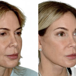 Deep Plane Facelift Before and After Photos in Miami, FL, Patient 29973