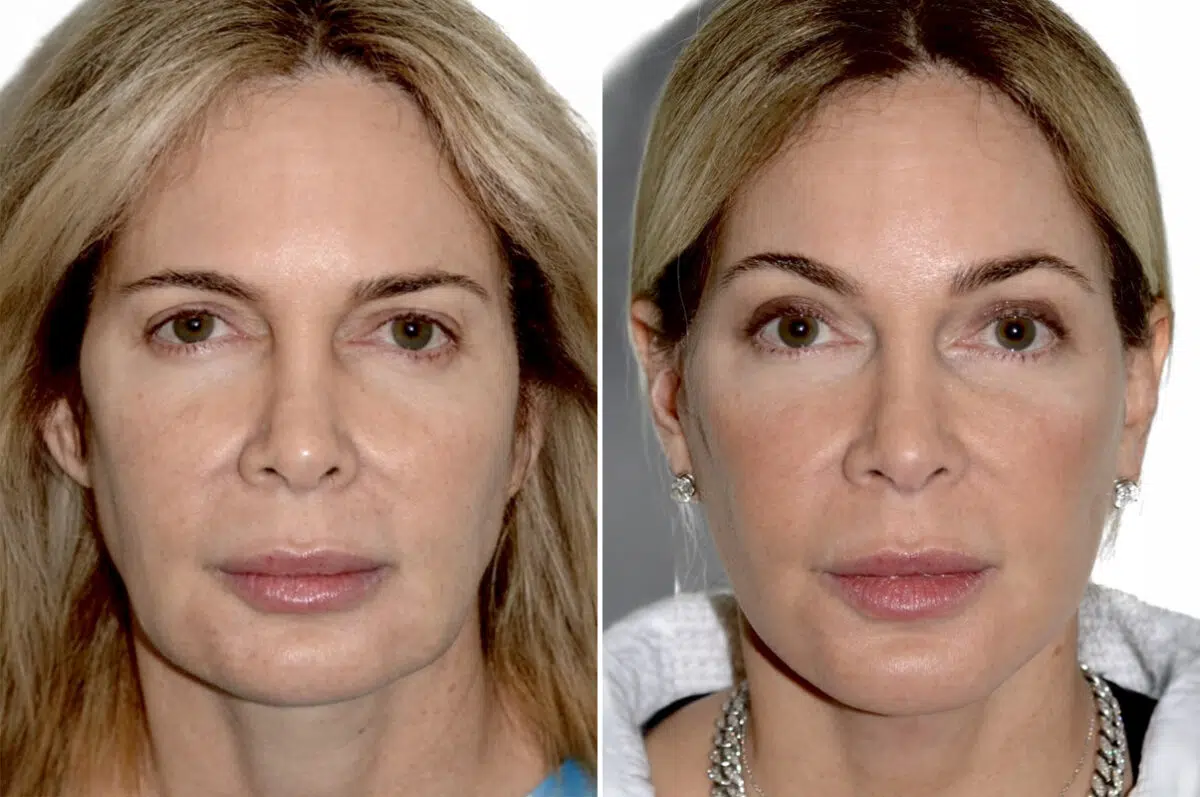 Deep Plane Facelift Before and After Photos in Miami, FL, Patient 29973