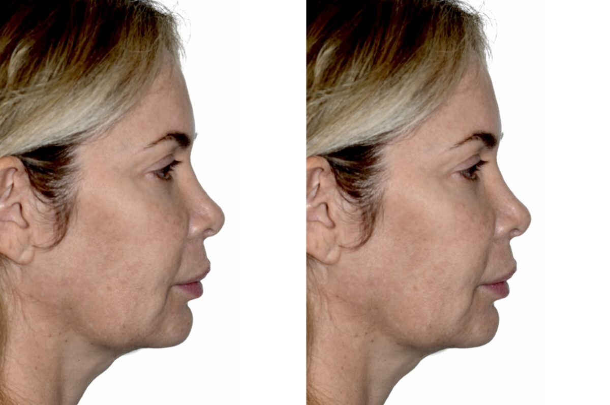 Deep Plane Facelift Before and After Photos in Miami, FL, Patient 29973