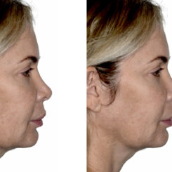 Deep Plane Facelift Before and After Photos in Miami, FL, Patient 29973