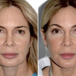 Deep Plane Facelift Before and After Photos in Miami, FL, Patient 29973