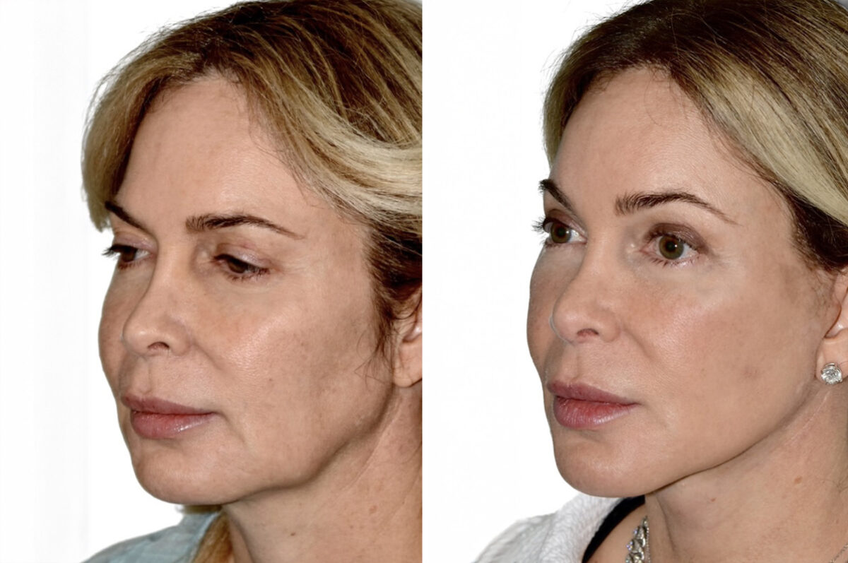 Deep Plane Facelift Before and After Photos in Miami, FL, Patient 29973