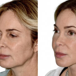 Deep Plane Facelift Before and After Photos in Miami, FL, Patient 29973