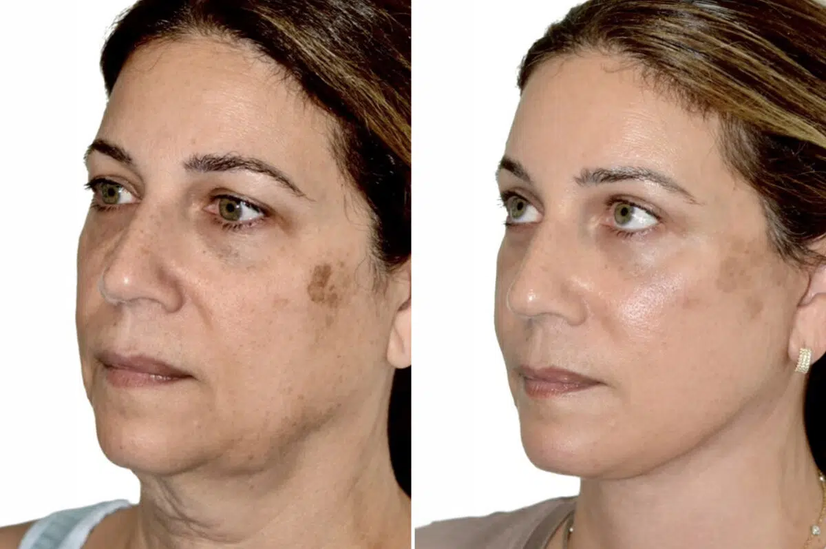 Brow Lift Before and After Photos in Miami, FL, Patient 29986