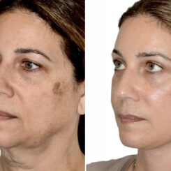 Brow Lift Before and After Photos in Miami, FL, Patient 29986