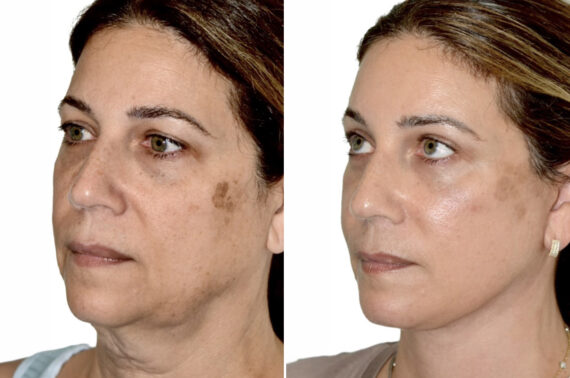 Brow Lift Before and After Photos in Miami, FL, Patient 29986
