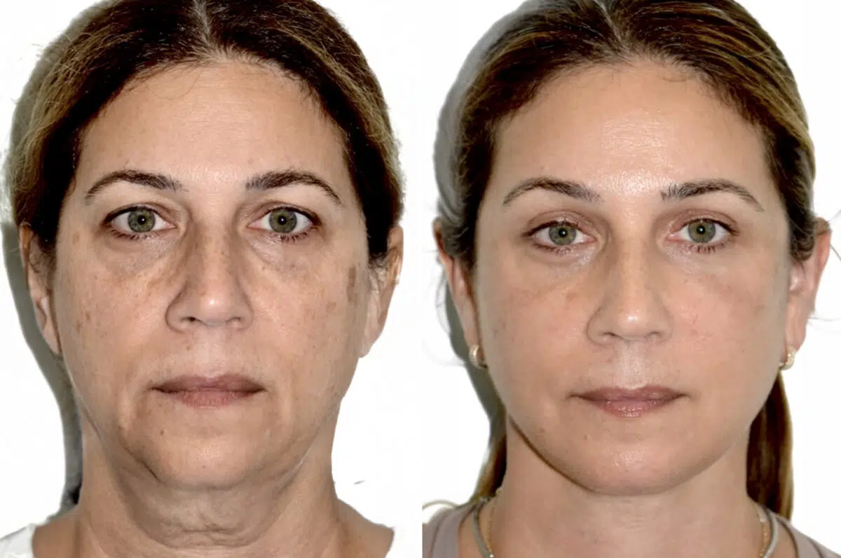Brow Lift Before and After Photos in Miami, FL, Patient 29986