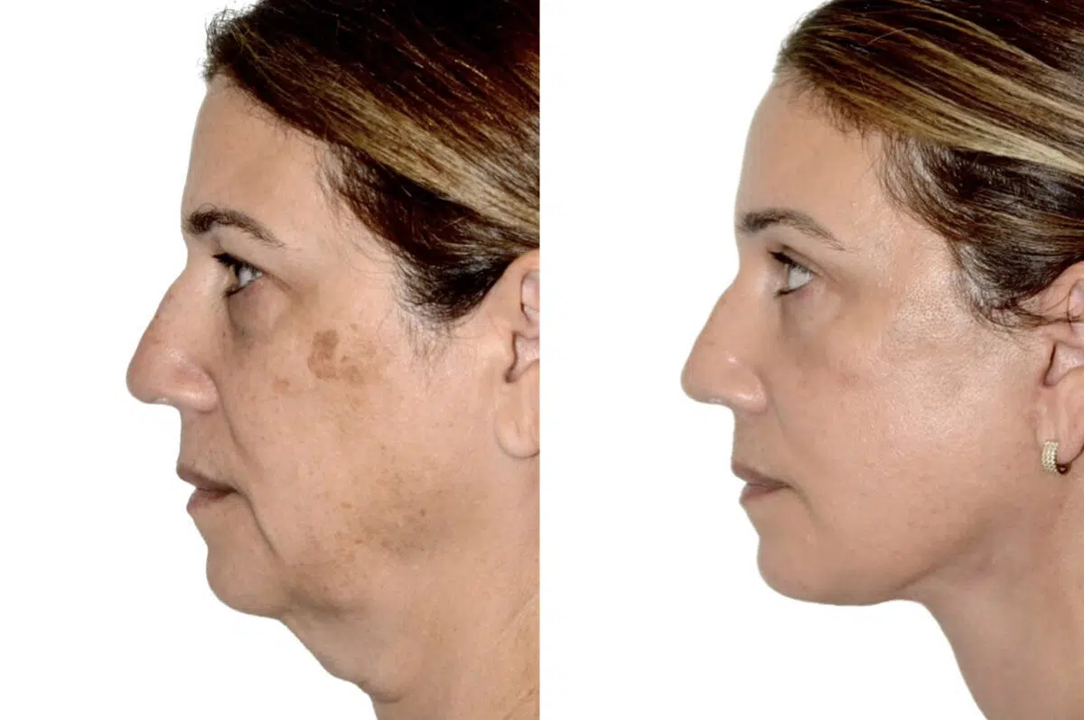 Brow Lift Before and After Photos in Miami, FL, Patient 29986