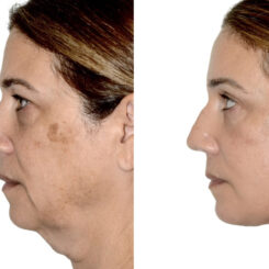 Brow Lift Before and After Photos in Miami, FL, Patient 29986