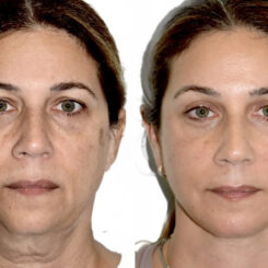 Brow Lift Before and After Photos in Miami, FL, Patient 29986