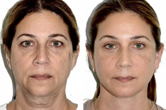 Nano Fat Transfer Before and After Photos in Miami, FL