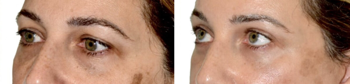 Blepharoplasty (eyelids) Before and After Photos in Miami, FL, Patient 29996