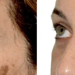 Blepharoplasty (eyelids) Before and After Photos in Miami, FL, Patient 29996