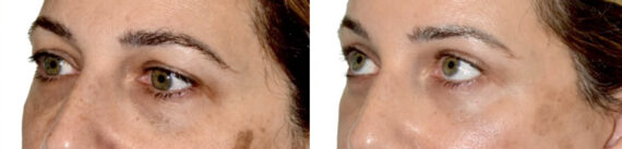 Blepharoplasty (eyelids) Before and After Photos in Miami, FL, Patient 29996