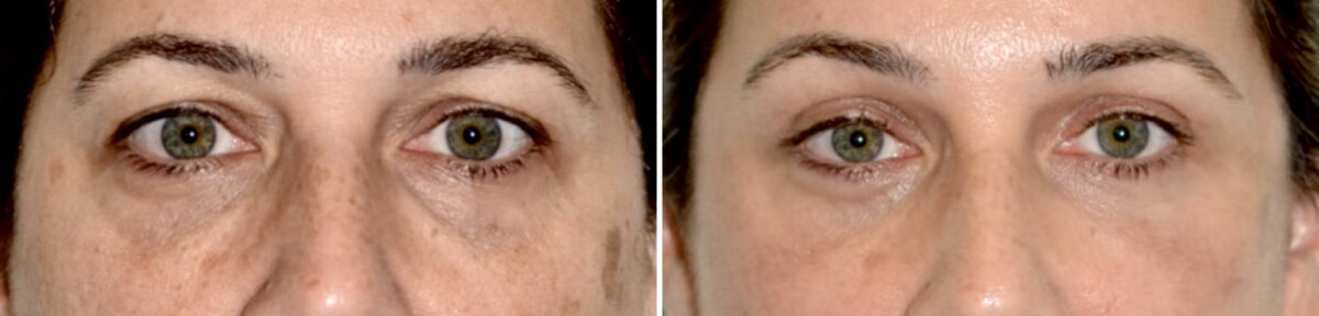 Blepharoplasty (eyelids) Before and After Photos in Miami, FL, Patient 29996