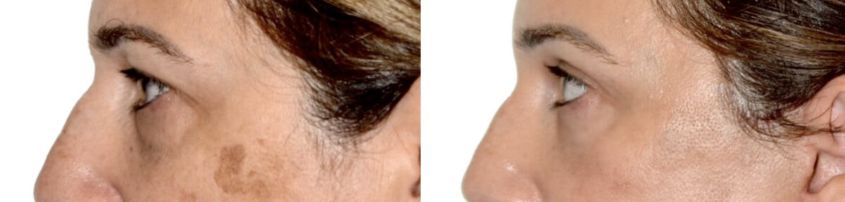 Blepharoplasty (eyelids) Before and After Photos in Miami, FL, Patient 29996