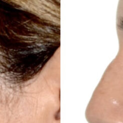 Blepharoplasty (eyelids) Before and After Photos in Miami, FL, Patient 29996