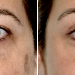 Blepharoplasty (eyelids) Before and After Photos in Miami, FL, Patient 29996